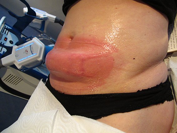 Cryolipolyse
